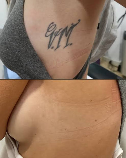 ELIMINADOR DE TATUAJES AYUDA A DESVANECER TINTA Y MARCAS EN LA PIEL